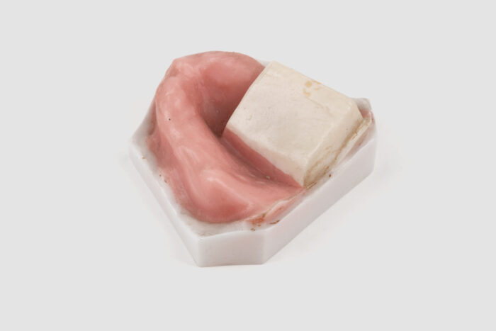 Cast with white dental stone and pink baseplate wax